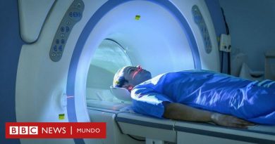 Covid prolongado: nuevos hallazgos revelan que puede provocar daños en órganos importantes - BBC News Mundo